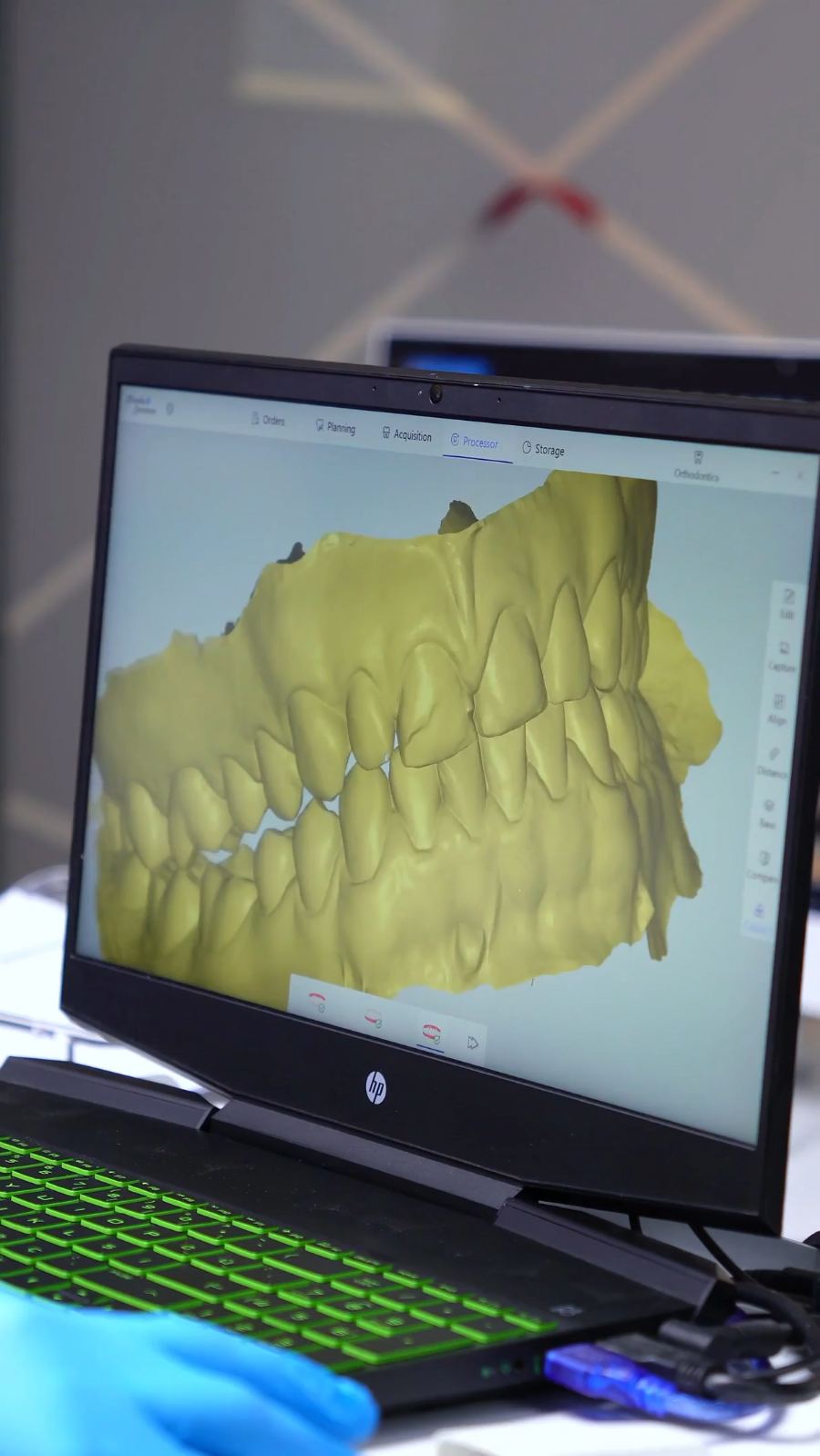 The Benefits of Orthodontic Treatment: More Than a Straight Smile