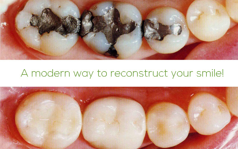 Replace amalgam to composite fillings at Elation Dental, 111 Bayswater Road, Croydon South, Vic 3136!